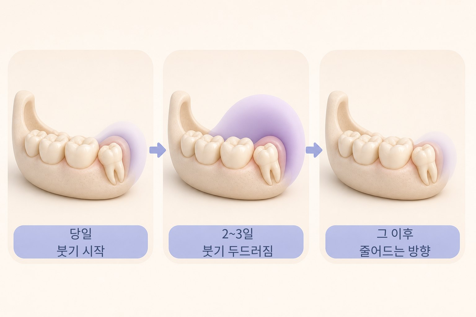 발치 당일부터 2~3일 사이 붓기가 두드러졌다가 이후 줄어드는 방향을 세 단계로 보여 주는 그림